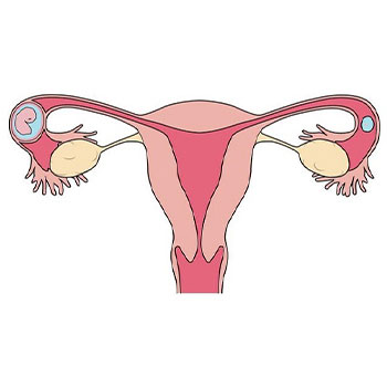  بارداری خارج از رحم چیست و چگونه درمان می شود؟