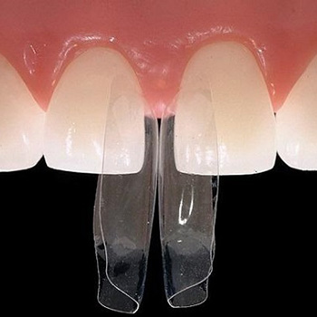 بستن فاصله بین دندان ها با کامپوزیت، ونیر، بریج و ارتودنسی