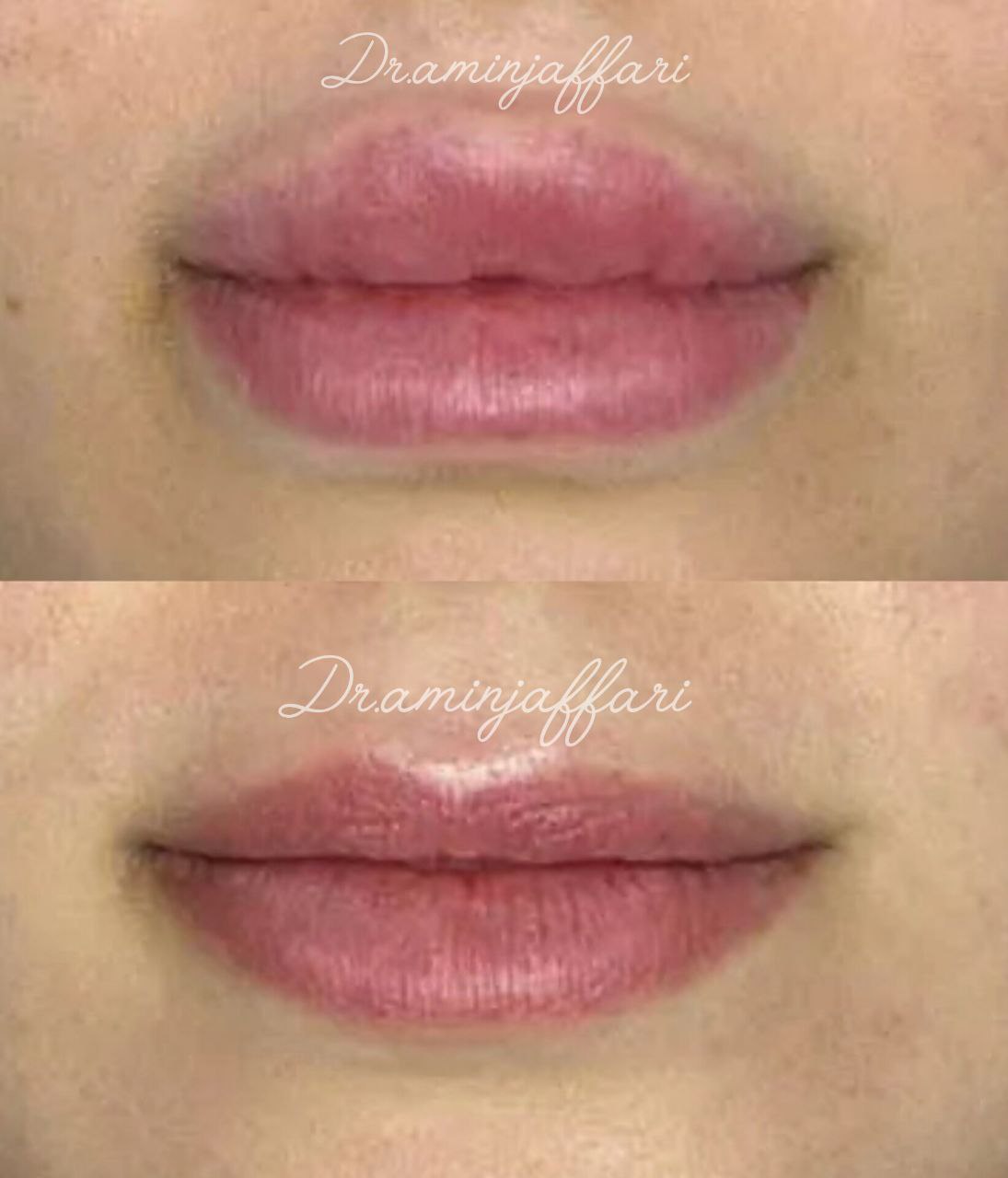 تخلیه انواع ژل های پاژ و سیلیکونی، راهنمای کامل و نکات کلیدی