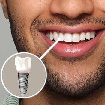ایمپلنت دندان فوری چیست، قیمت آن چقدر است؟