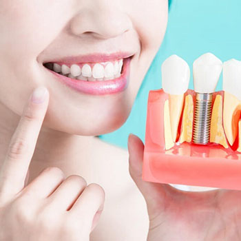 چطور بدون جراحی دندان های خود را ایمپلنت کنیم؟