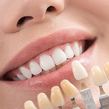 بهترین نوع لمینت دندان کدام است؟