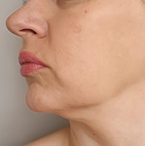خارج سازی نخهای لیفت عفونت کرده