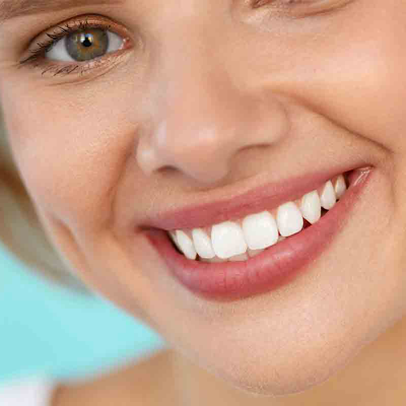 قیمت کامپوزیت دندان سال ۱۴۰۰، روش سفیدی دندان