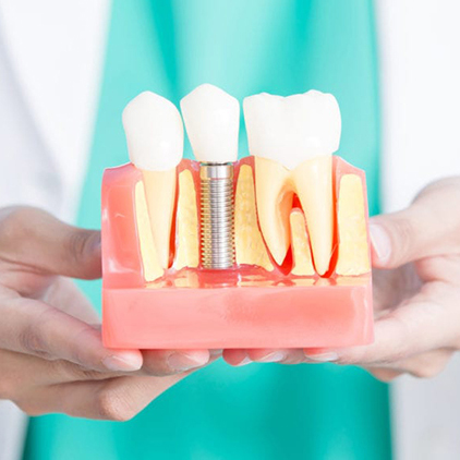 درباره ایمپلنت دندان
