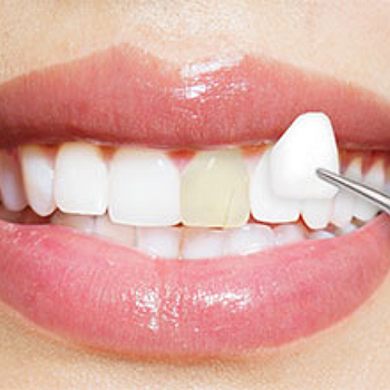 ۶ فرق اصلی و جالب روکش دندان با لمینت و ونیر کامپوزیت‌ها