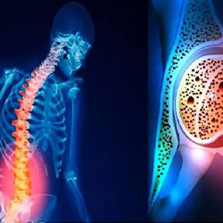 چرا باید تست سنجش تراکم استخوان بدهیم؟